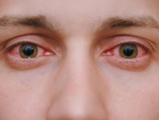 Secreción ocular: síntomas de esta afección que puede ser de preocupación