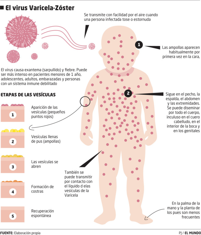  La Libertad: tres de los seis menores muertos por varicela están en esta región