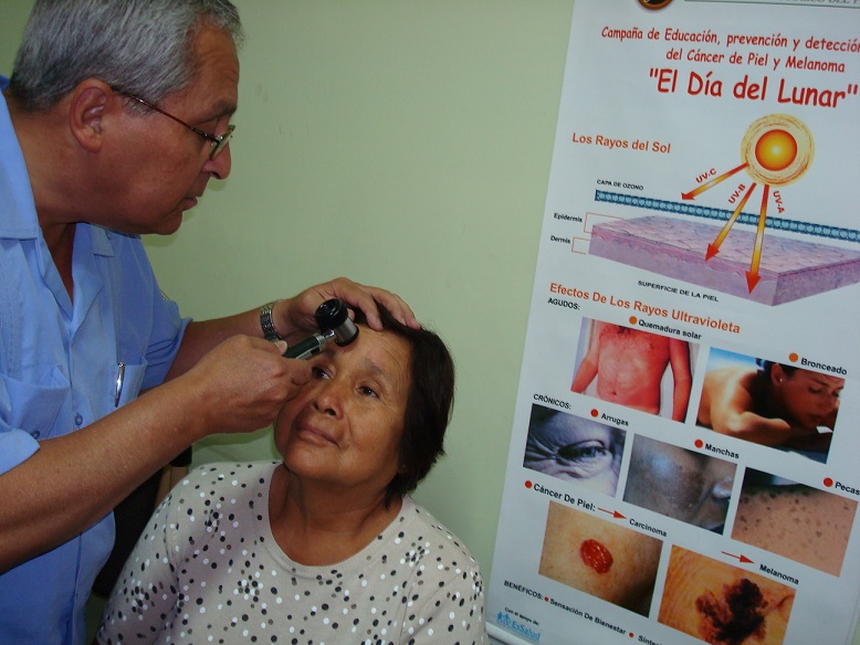 Minsa programa campaña nacional de detección de cáncer a la piel por el “Día del lunar”