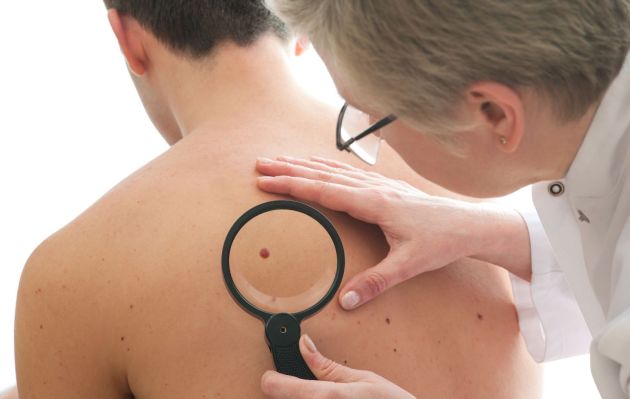 Incrementan casos de lesiones malignas sospechosas de cáncer de piel en Perú