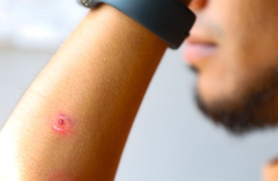 Minsa alerta aumento de riesgo de picaduras y mordeduras de insectos en verano