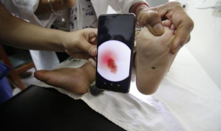 Le informamos cómo reconocer un lunar cancerígeno