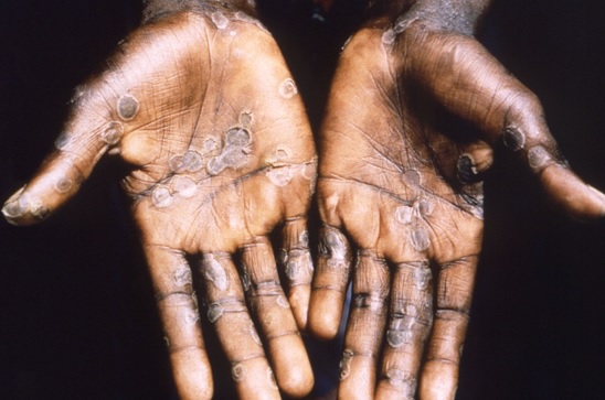 Viruela del mono: más de 200 casos confirmados en 19 países 