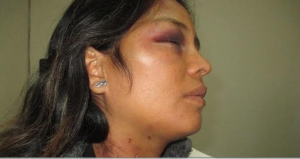 Chofer de combi desfiguró a conviviente en Chiclayo