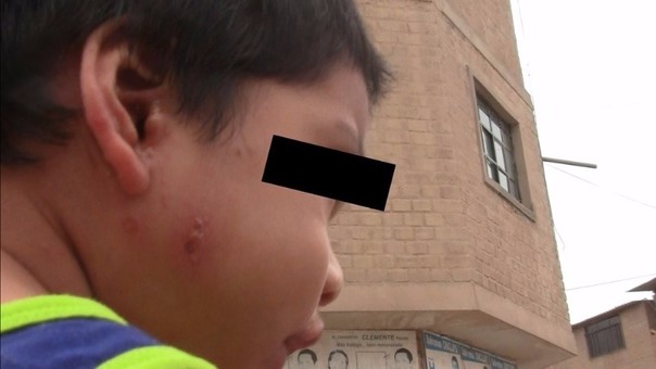 Niño de dos años es víctima de infección a su piel por el colapso de desagües en JLO