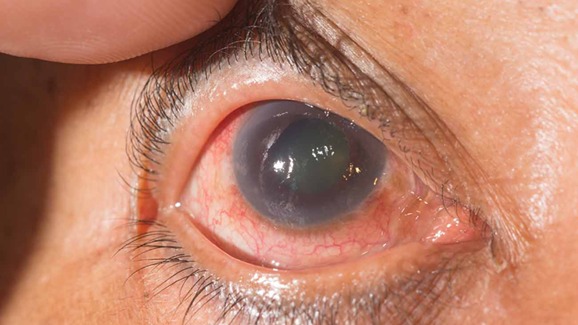 Glaucoma, la ceguera silenciosa