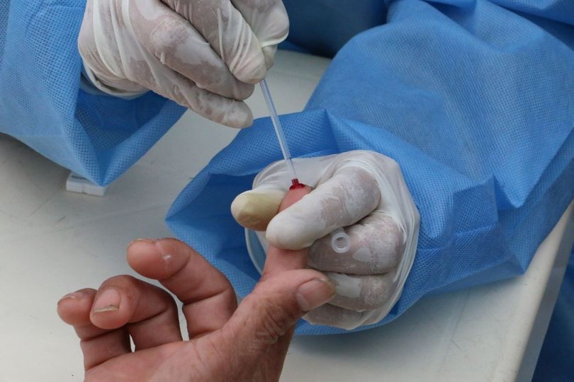 Viruela del mono: aumentan a 340 los casos confirmados en el país